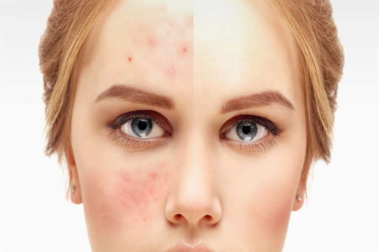 چگونه کرم ترتینوئین به درمان آکنه کمک می‌کند؟