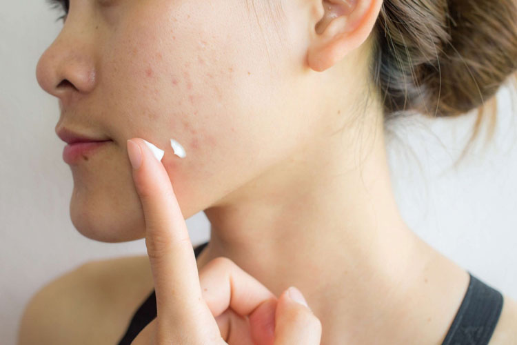 نحوه استفاده از کرم ترتینوئین