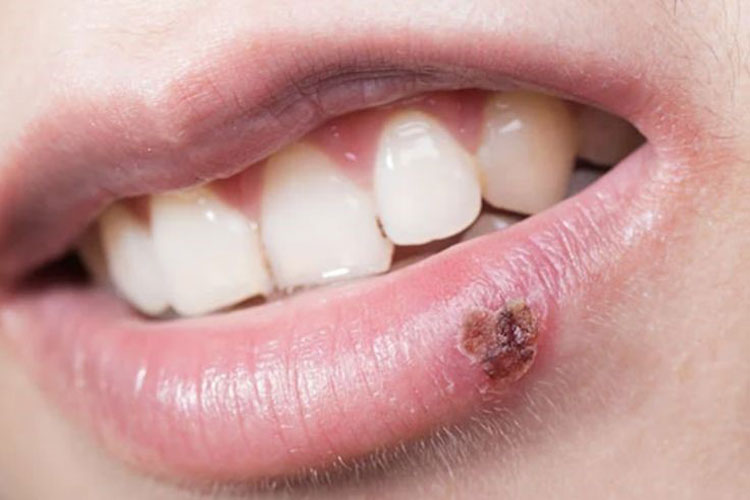 چرا تبخال لب ممکن است در دوران استرس شدید بروز کند؟