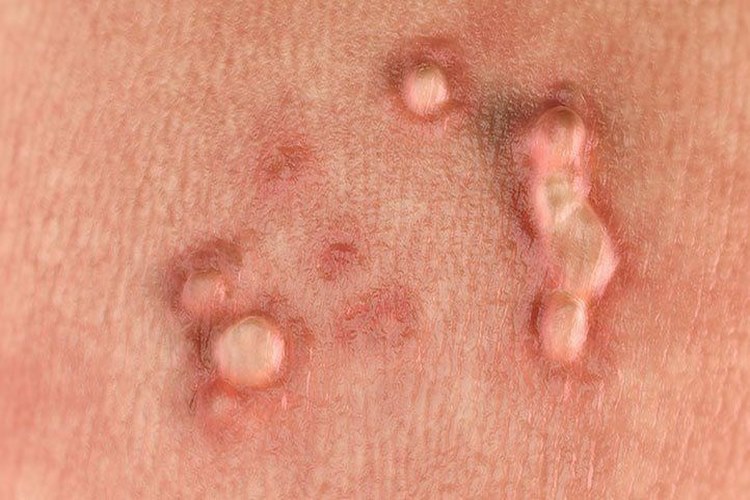 پیشگیری از انواع زگیل تناسلی