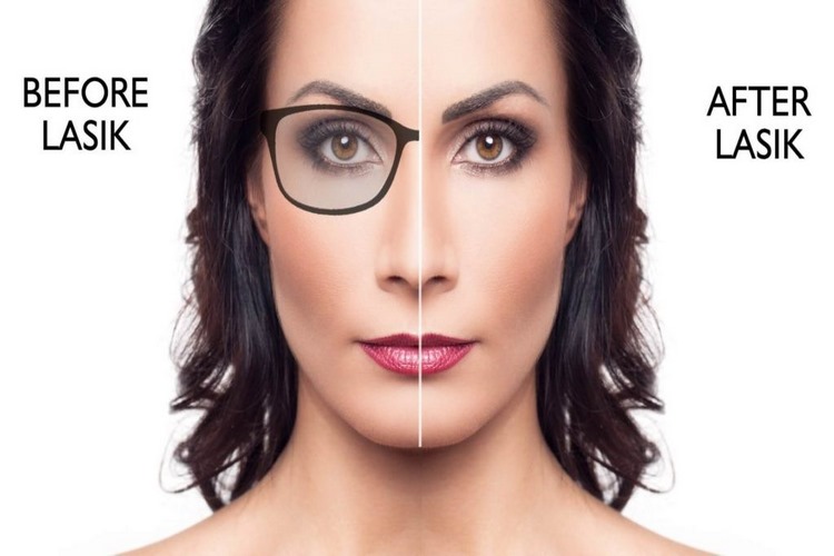 عمل لیزیک چشم برای چه کسانی مناسب است؟