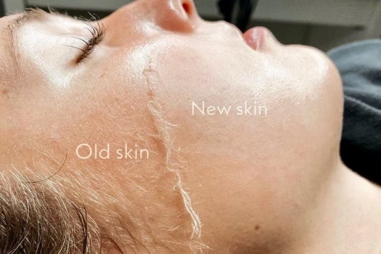 چگونه درماپلنینگ صورت را در خانه انجام دهیم؟