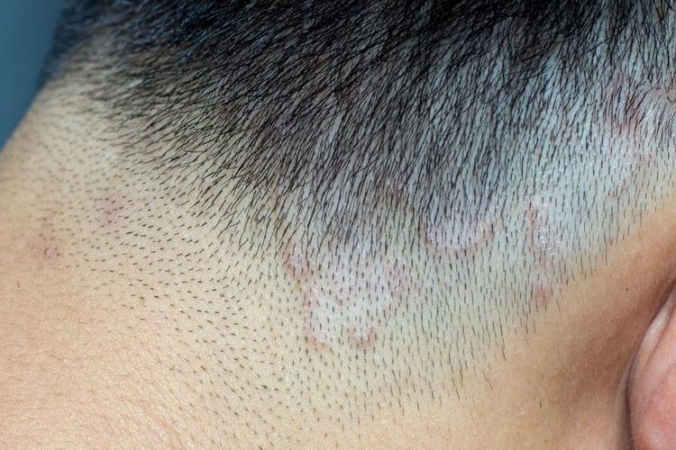 چگونه قارچ پوست سر را درمان کنیم؟ روش‌ها و درمان‌های خانگی