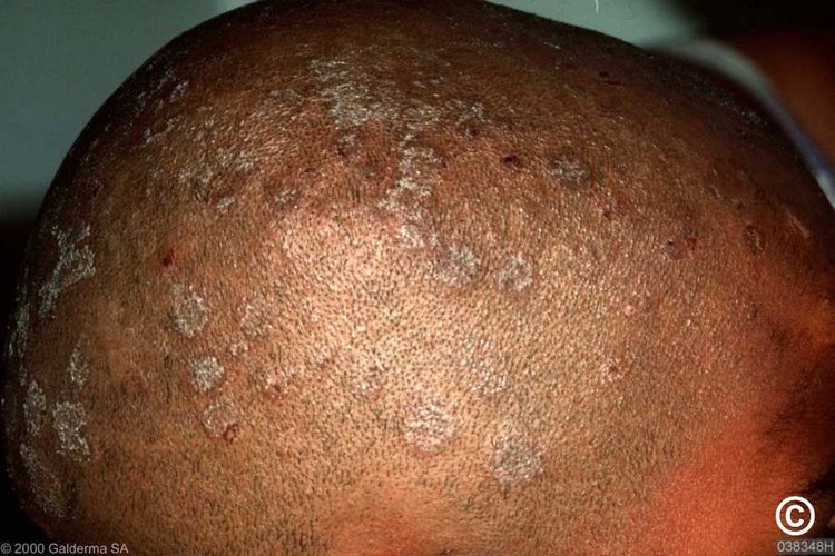 مراقبت‌های روزانه برای جلوگیری از قارچ پوست سر چیست 