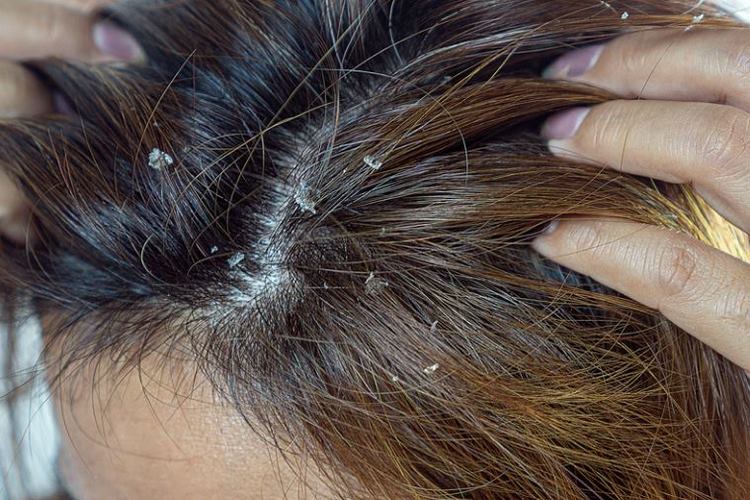 علت پوسته سر چیست؟