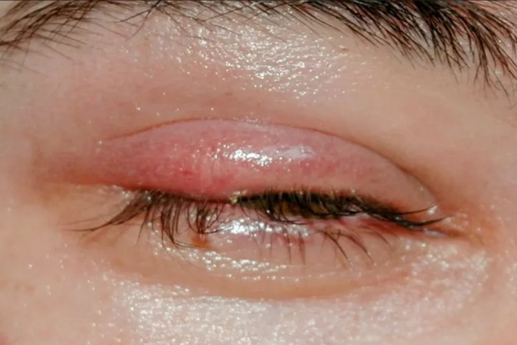 چگونه از بروز گل مژه پیشگیری کنیم؟