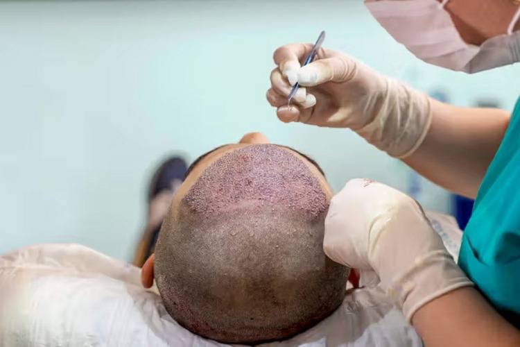 بهترین روش کاشت مو
