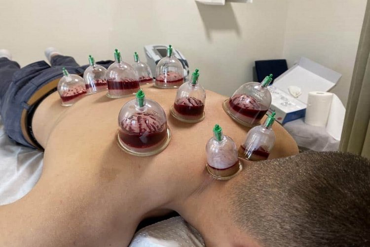 بهترین زمان حجامت