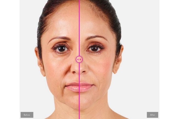 انواع فیلرهای خط خنده و مزایای هر کدام