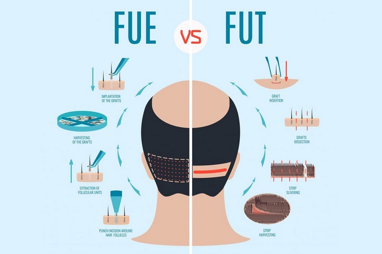 کاشت مو چیست و چرا به آن نیاز داریم؟