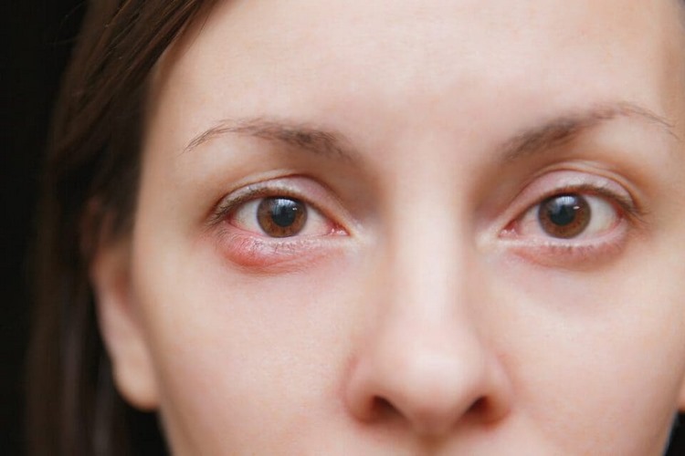 گل مژه چیست و چرا ایجاد می‌شود؟
