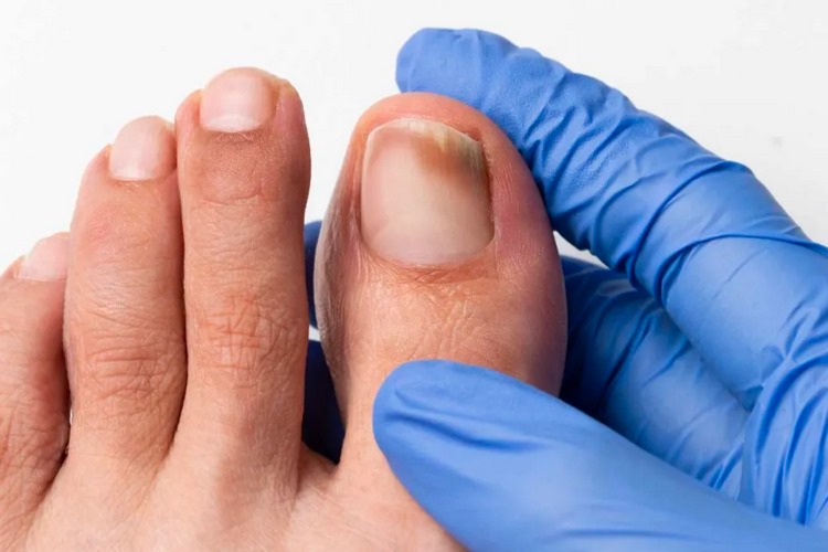 علت ابتلا به قارچ ناخن بعد از کاشت چیست؟