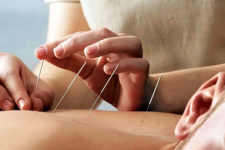 عوارض و نکات احتیاطی طب سوزنی برای دیسک کمر
