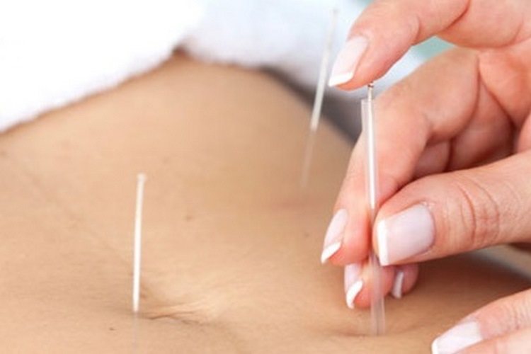 روش انجام طب سوزنی برای لاغری شکم و پهلو