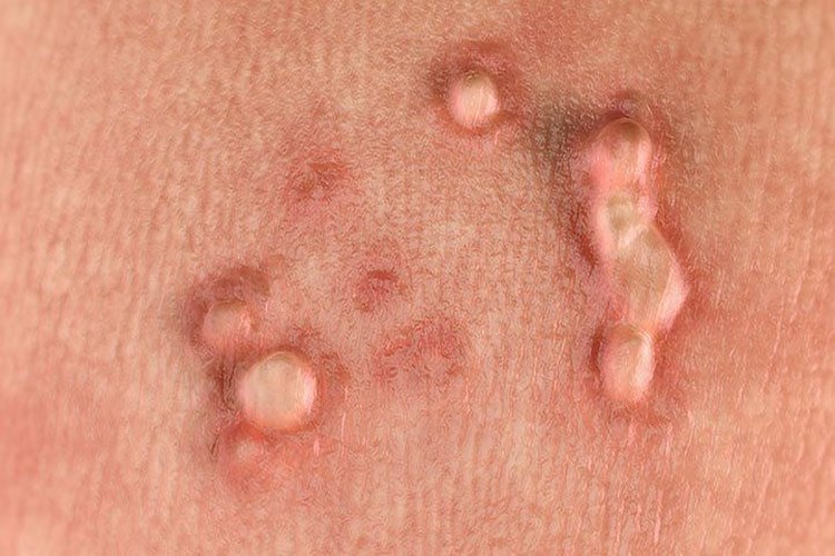روش‌های پیشگیری از ابتلا به HPV