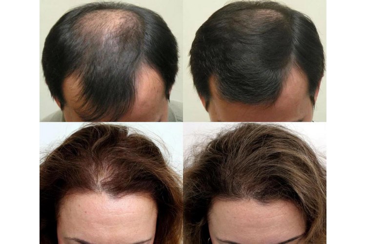 دلایل اصلی ریزش مو و نقش تونیک در درمان آن
