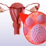 ویروس HPV چیست؟