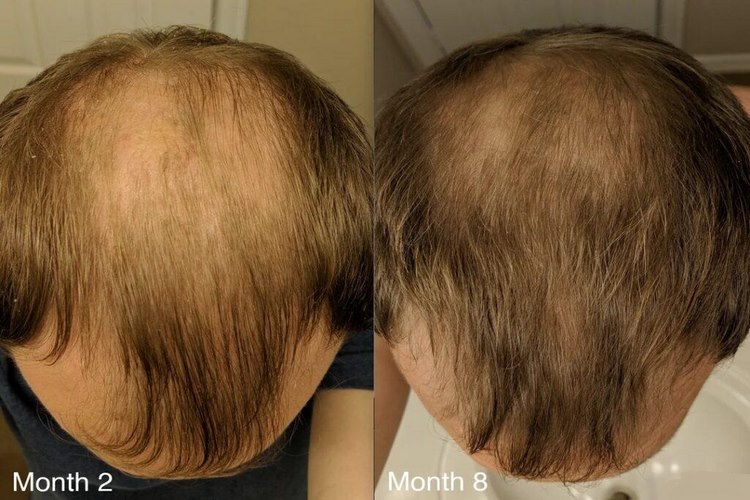 چه کسانی به ماساژ پوست سر نیاز دارند؟