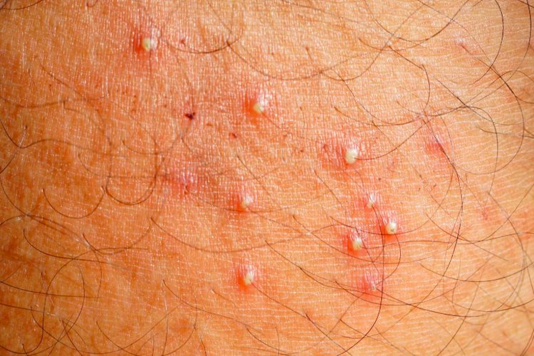 فولیکولیت چگونه به وجود می‌آید؟