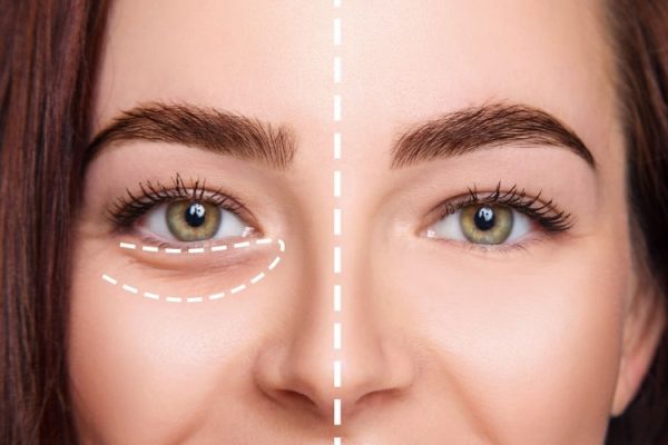 فیلر چشم چیست؟
